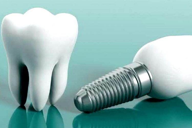 Dental implant Elazıg