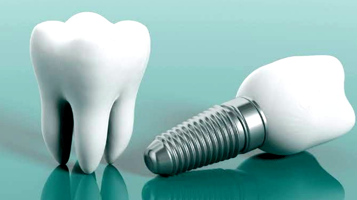 Dental implant Elazıg