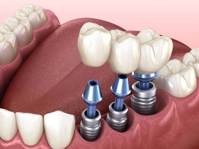 Dental implant tedavisi Elazığ