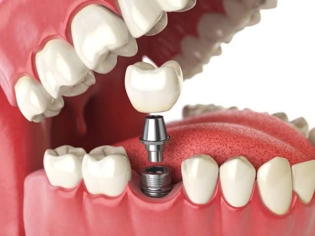 Tek Diş Dental implant Elazığ