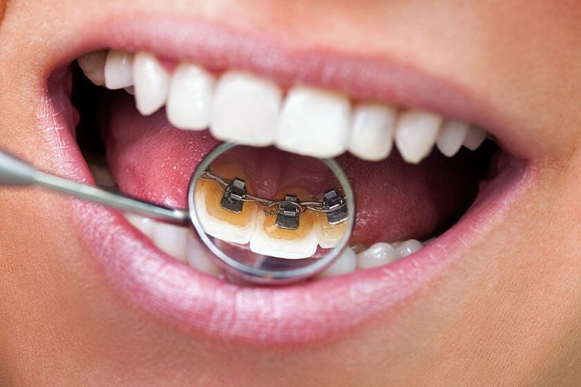 DentaElazığ Diş teli uygulaması