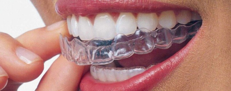 Elazığ Şeffaf Plak invisalign