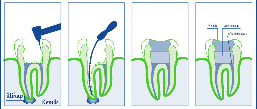 Elazığ Diş Kliniği Kök Kanal Tedavisi