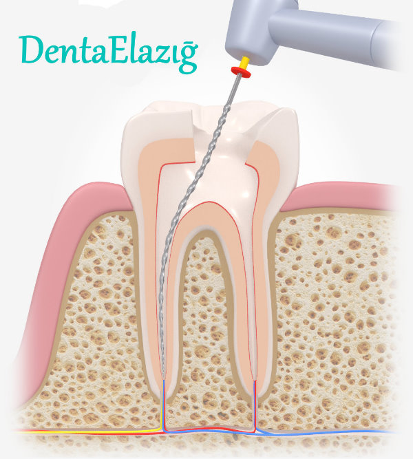 Kök Kanal Tedavisi (Endodonti)