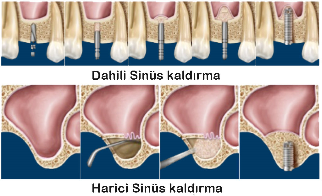 Sinus Lifting Elazığ