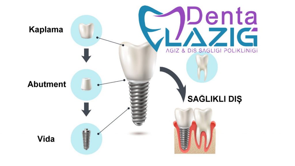 Tek Diş implant - Denta Elazığ Ağız ve Diş Sağlığı Polikliniği
