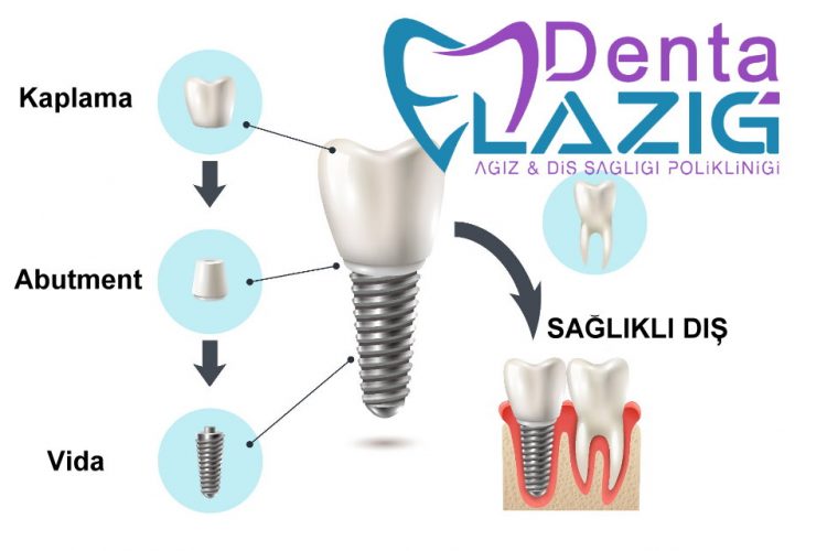 DentaElazig Tek Dis Implant 2023-2024