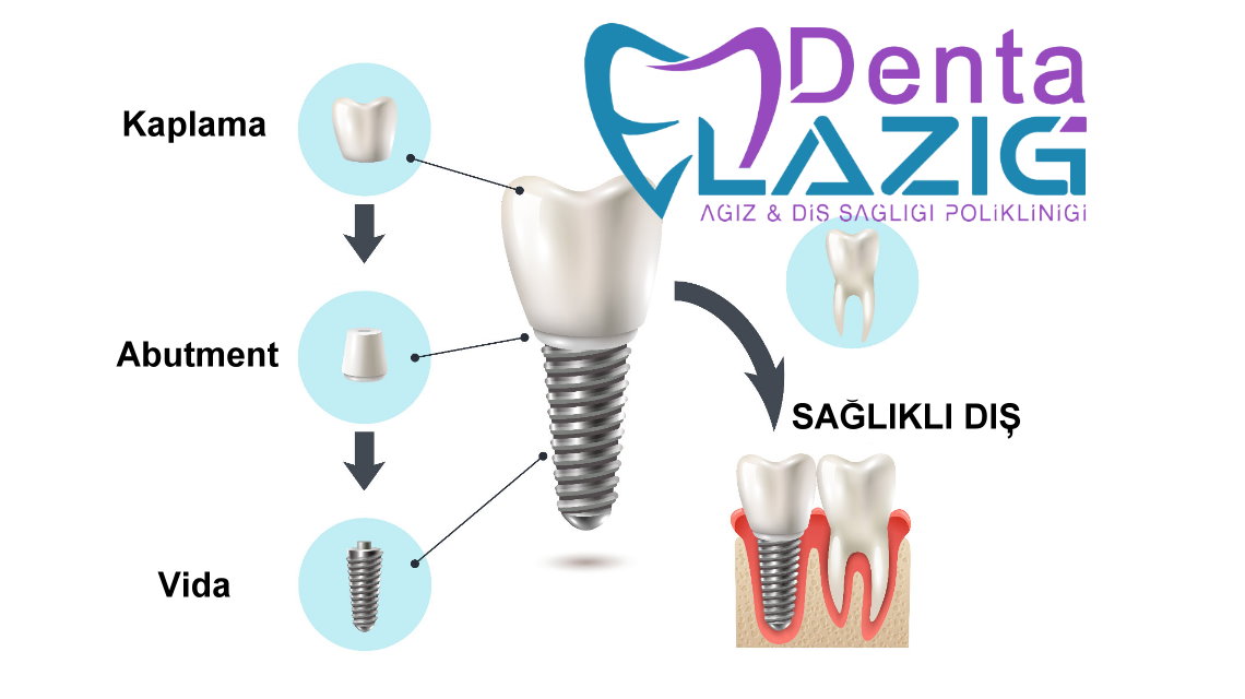 DentaElazig Tek Dis Implant 2023-2024