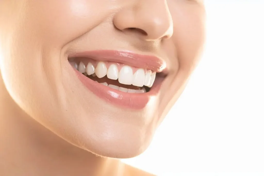 E-Max Veneers