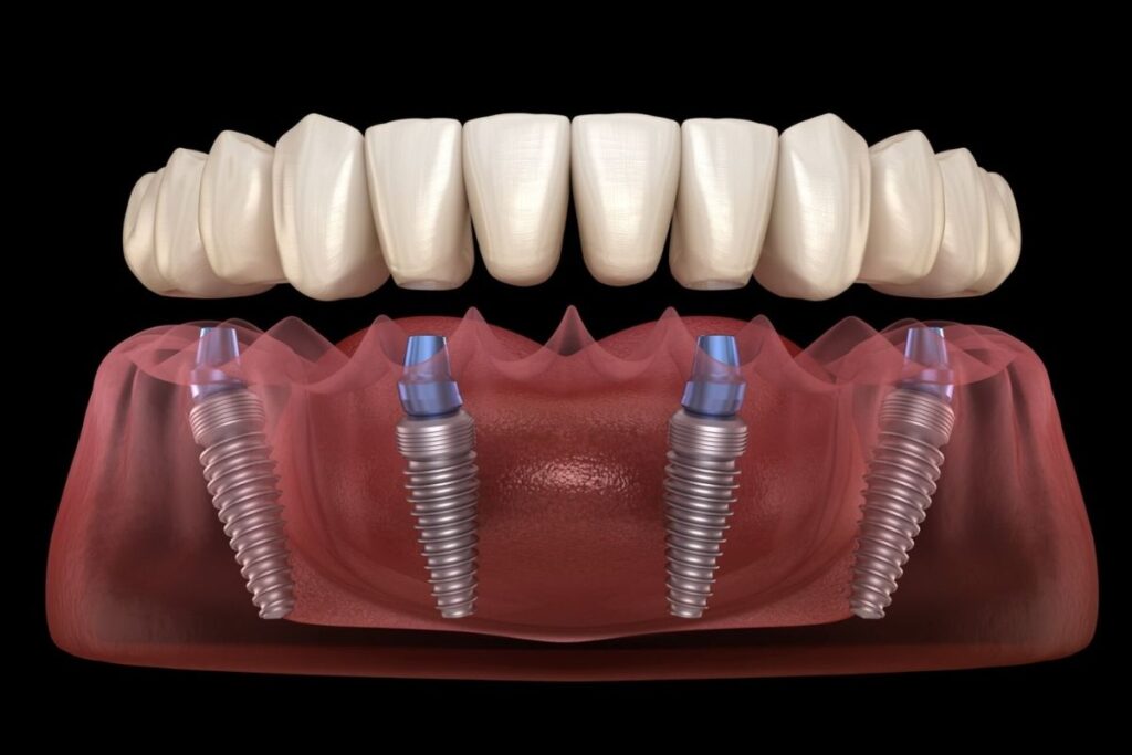 dental-implants