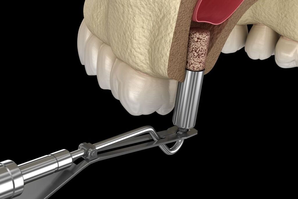 Sinus Lifting